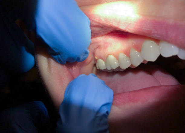 Urgent Tooth Repair in CA